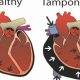 Understanding Muffled Heart Sound: Causes &amp; Diagnosis | Best Mufflers for Cars & Trucks | Performance, Sound & Durability Upgrades