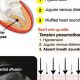 Understanding Muffled Heart Sounds: Causes &amp; Risks | Best Mufflers for Cars & Trucks | Performance, Sound & Durability Upgrades