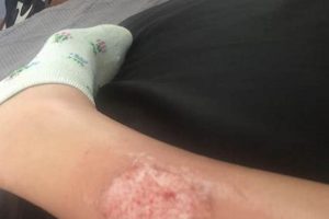 Exhaust Inferno: Muffler Burn on Leg &amp; Healing | Best Mufflers for Cars & Trucks | Performance, Sound & Durability Upgrades