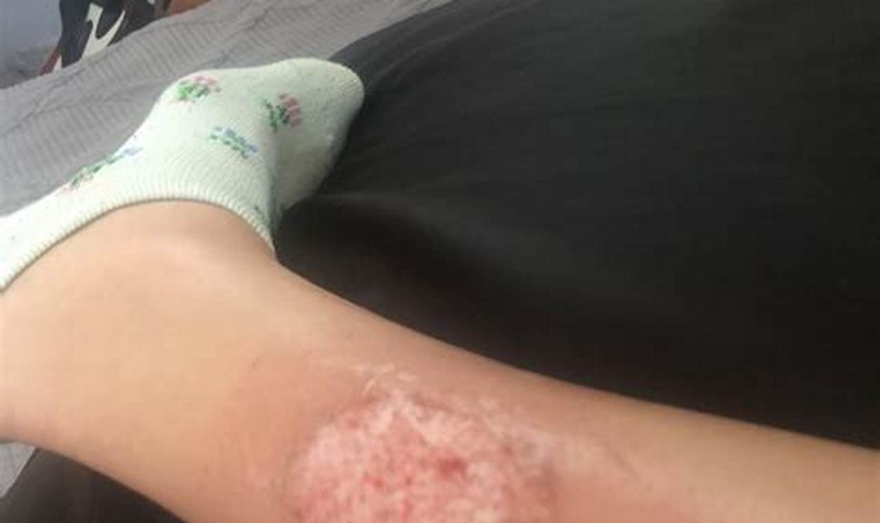 Exhaust Inferno: Muffler Burn on Leg &amp; Healing | Best Mufflers for Cars & Trucks | Performance, Sound & Durability Upgrades